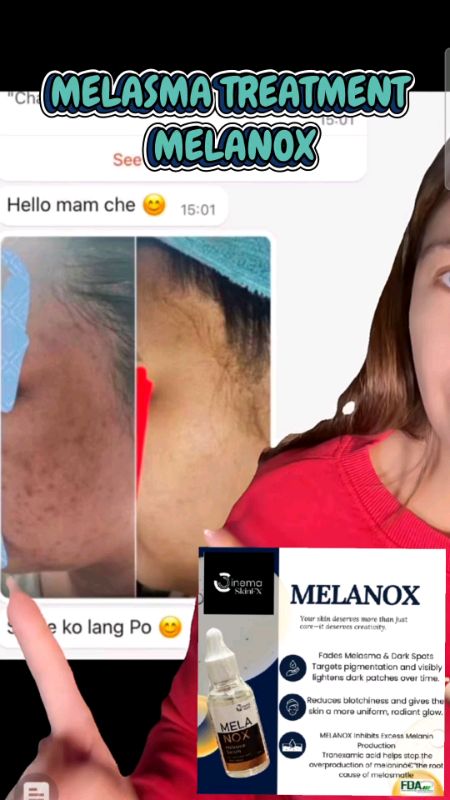 #freecoinsinshopeevideo #masmurasashopee #shopeePhpaydaysale #hugotsashopee #viral #trending #melasma #Melanox #cinemaskinfx #skincare #Face #skin